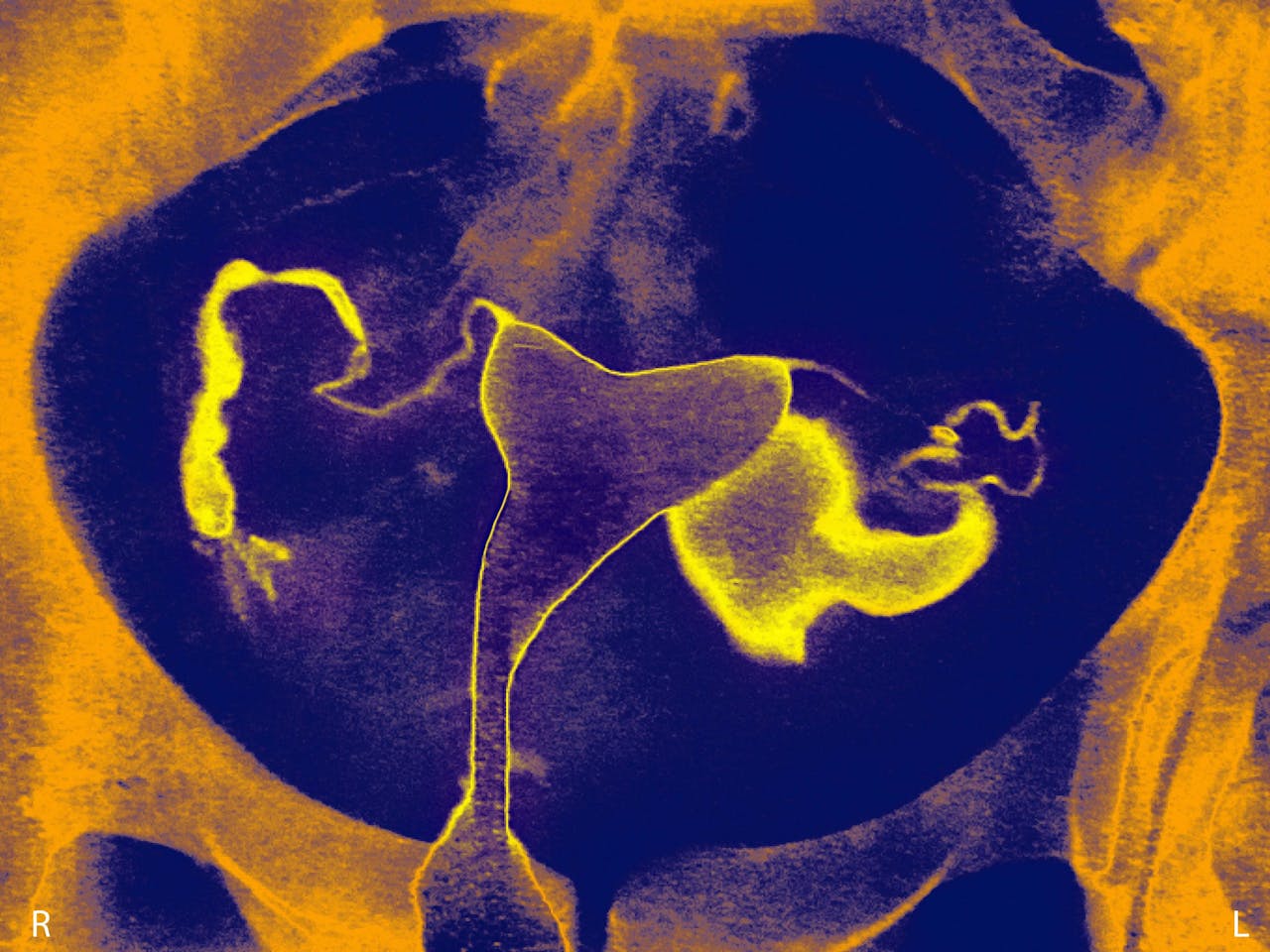 Een röntgenfoto van het bekken van een vrouw. Dankzij een contrastvloeistof is de doorgankelijkheid van eileiders in beeld gebracht.