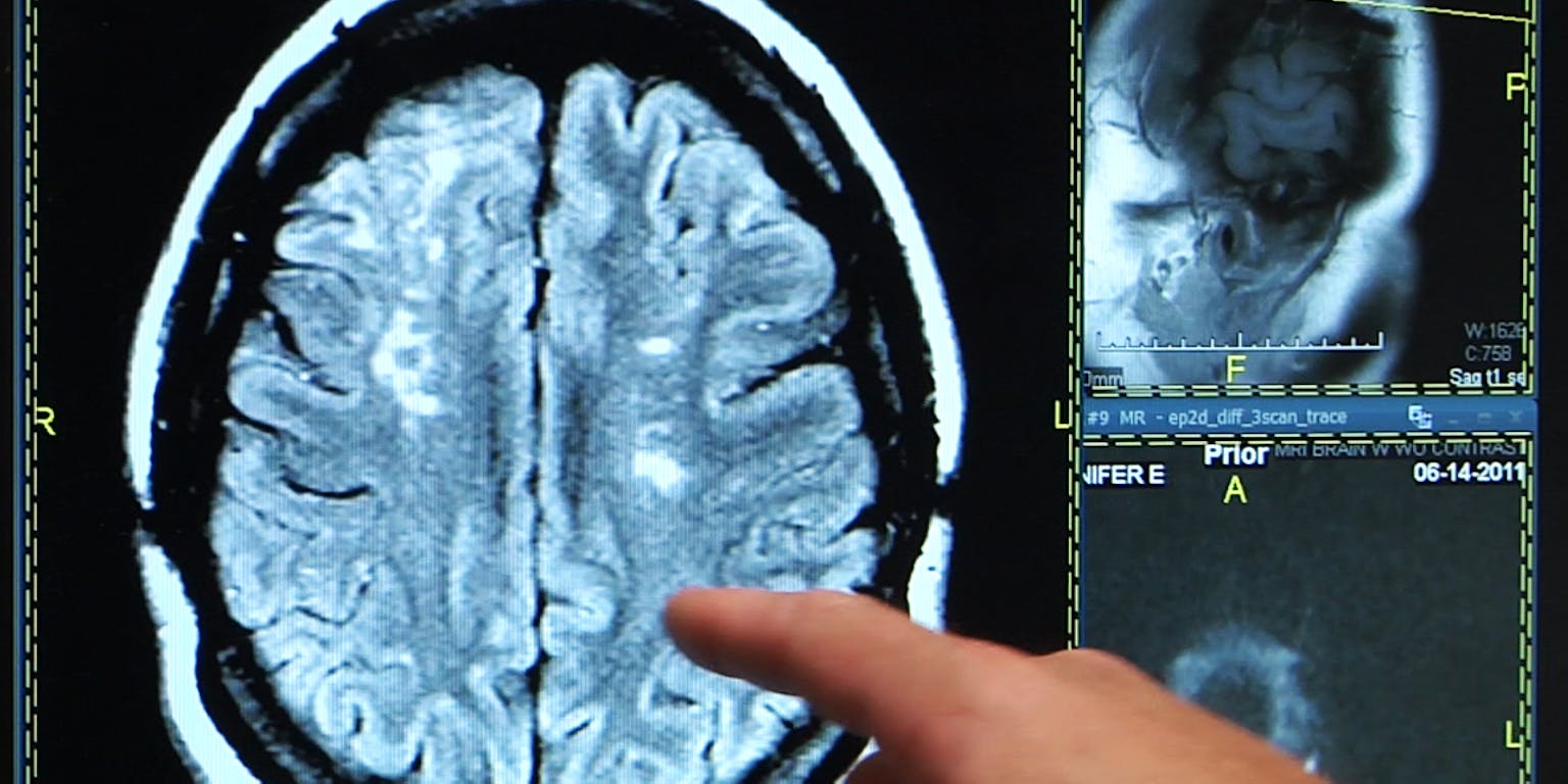 Een persoon wijst naar een MRI-beeld van hersenen.