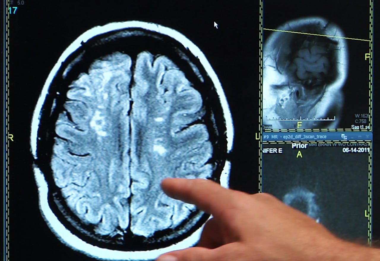 Een persoon wijst naar een MRI-beeld van hersenen.