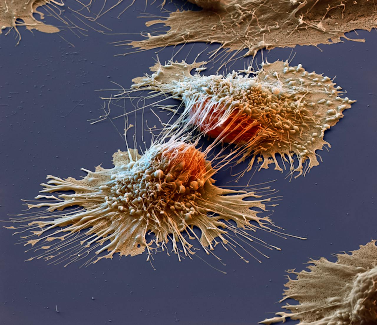 Op een blauwe achtergrond wordt een groep kankercellen weergegeven.