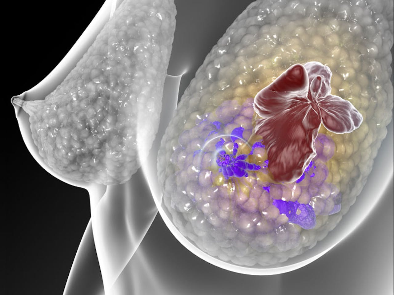 Een tekening van een vrouw met borstkanker, die de doelgerichte therapieën Trastuzumab en lapatinib krijgt.
