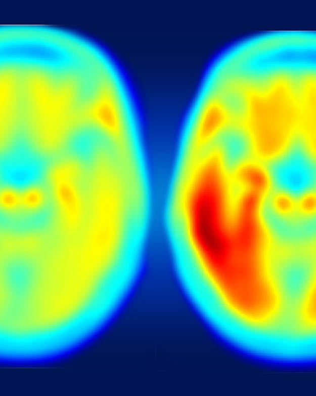 Hoe roder de kleur, hoe meer tau-eiwit in de hersenen. Links het gemiddelde brein van iemand die cognitief gezond is, waar ook wat tau is opgehoopt. In mensen met milde symptomen van de ziekte van Alzheimer (rechts) is er veel meer samenklontering van tau. Er is een verband tussen de hoeveelheid tau en de ernst van cognitieve problemen. Twee hersenscans naast elkaar. Links het gemiddelde brein van iemand die cognitief gezond is. Rechts een brein van mensen met milde symptomen van de ziekte van Alzheimer.