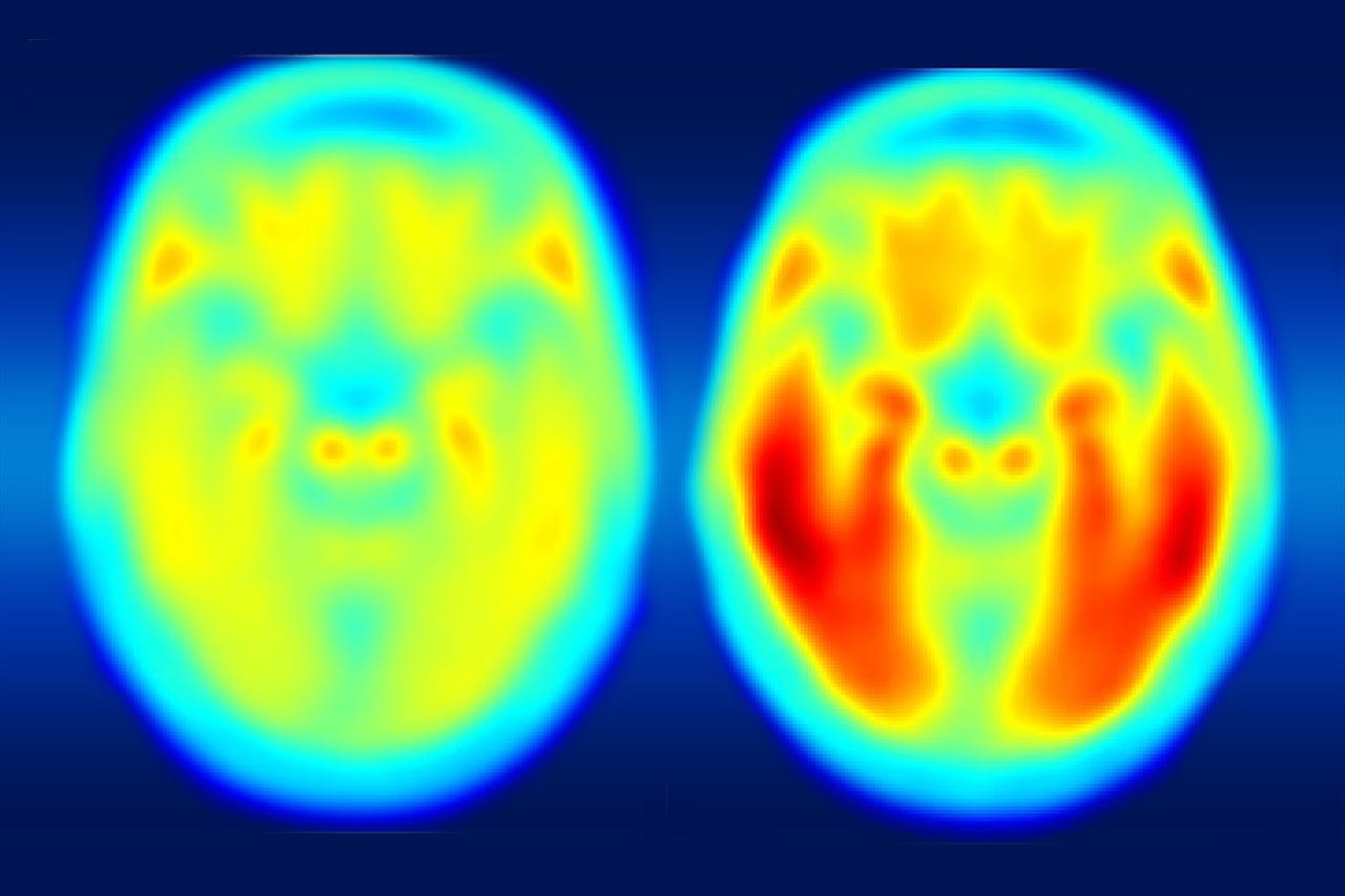 Twee hersenscans naast elkaar. Links het gemiddelde brein van iemand die cognitief gezond is. Rechts een brein van mensen met milde symptomen van de ziekte van Alzheimer.