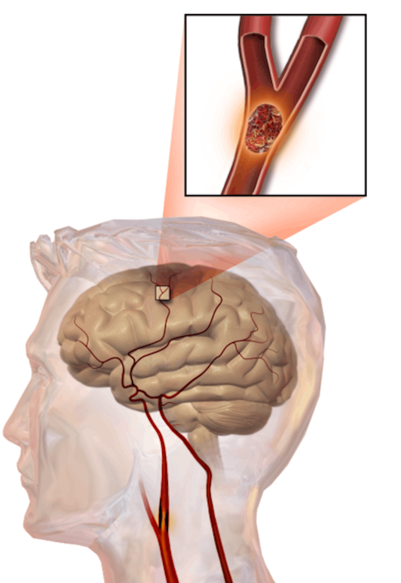 De hersenen, waar een geblokkeerd bloedvat in beeld is gebracht als detail.