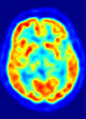 Een PET-scannerafbeelding van hersenen.