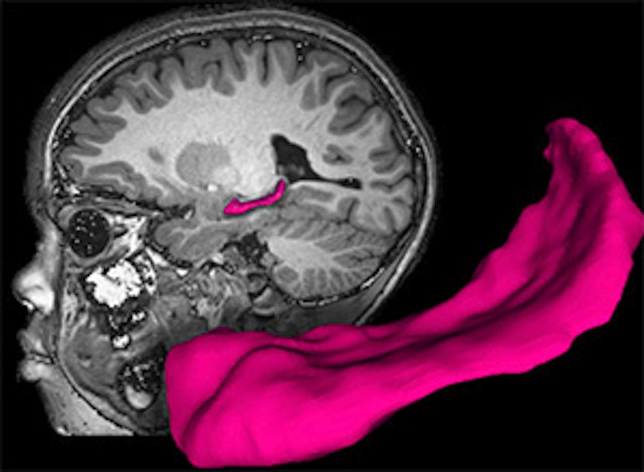 Een MRI-afbeelding van kinderhersenen met de hippocampus aangegeven in het roze en uitvergroot.