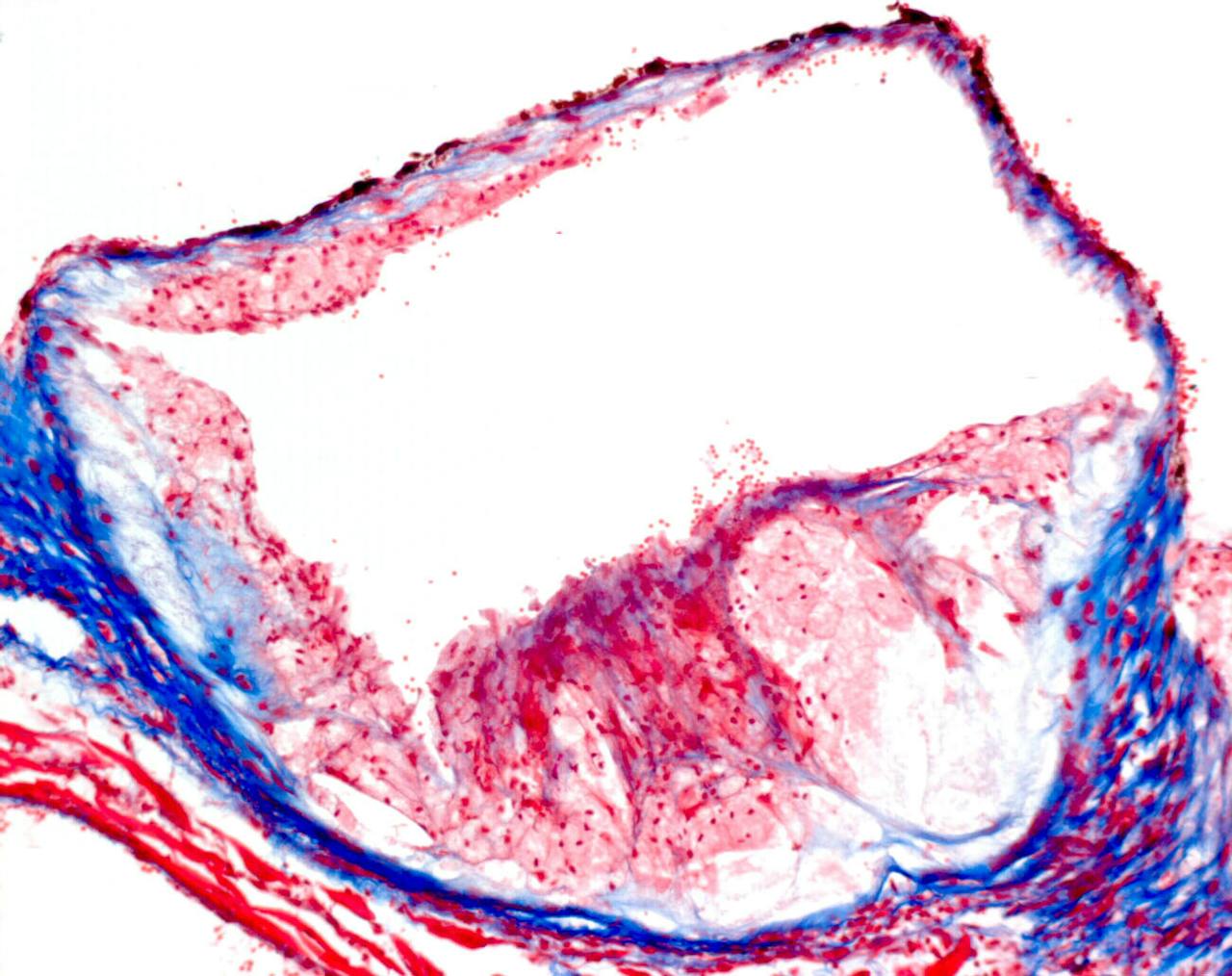 Doorsnede van het begin van de grote lichaamsslagader van een muis met daarin een atherosclerotische plaque. Weergegeven in het rood en blauw.