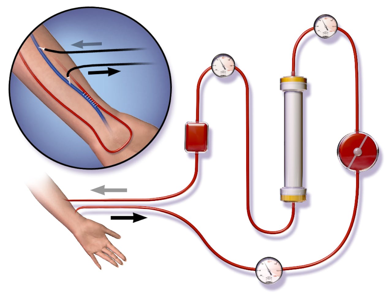 Dialyse met behulp van een shunt. In het rondje linksboven zie je hoe de shunt is aangelegd. De witte streepjes vormen een chirurgische verbinding tussen de slagader (rood) en de ader (blauw). Bij dialyse wordt de ader aangeprikt met twee naalden. Vanuit de onderste naald stroomt het bloed naar het dialyse-apparaat. Via de bovenste naald stroomt het bloed terug in het lichaam. Op de grote afbeelding kun je zien hoe de shunt is aangesloten op het dialyse-apparaat.