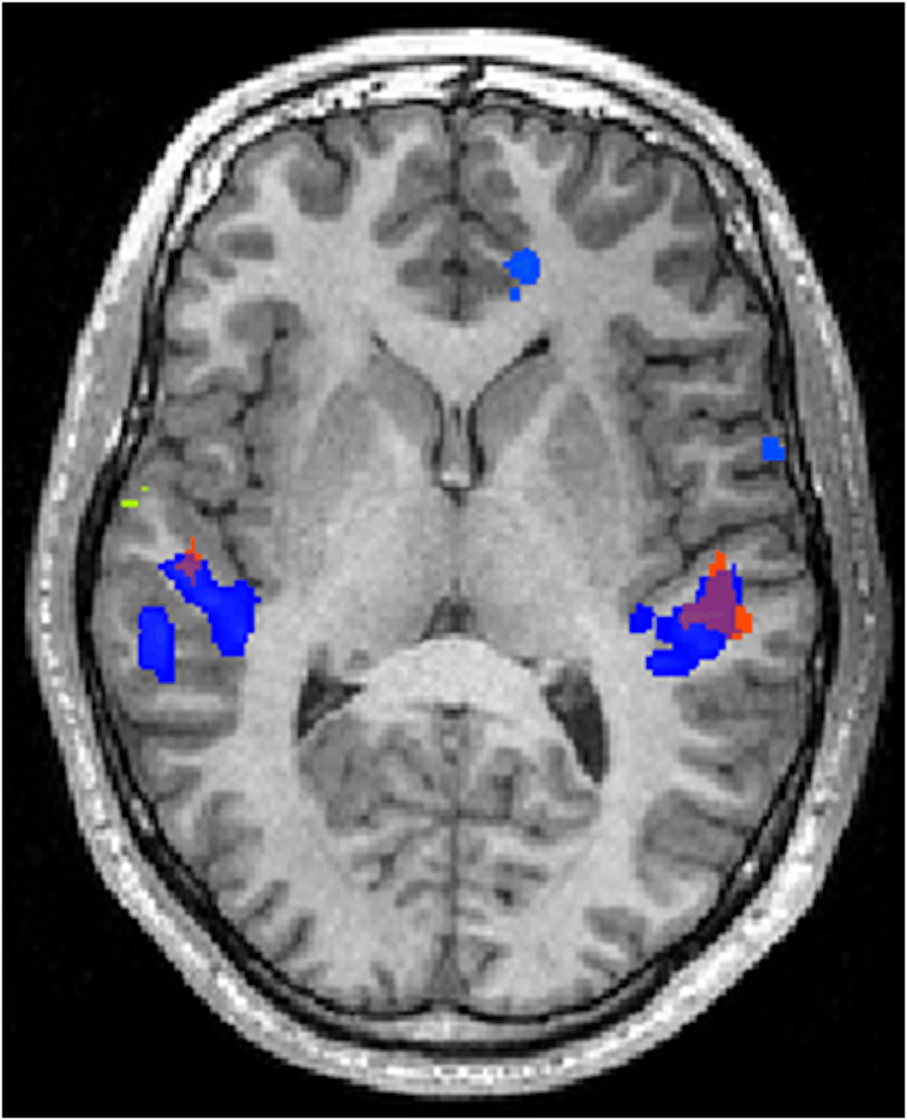Een MRI-beeld van iemand zijn hersenen. Op het MRI-beeld zijn een paar blauwe vlekken aangegeven.