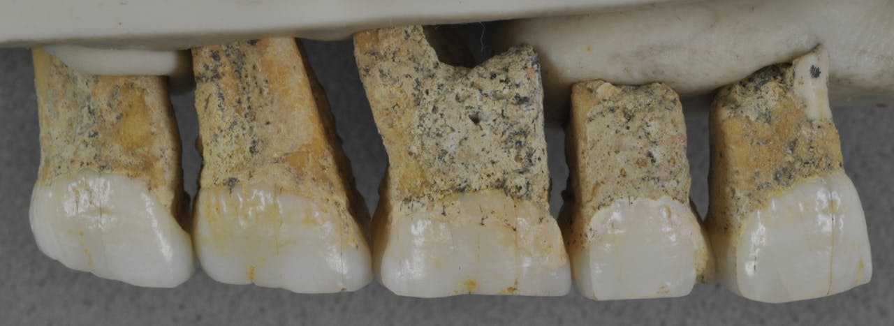 Een aantal tanden van de menssoort 'Homo luzonensis'. Ze zijn 50.000 tot 70.000 jaar oud en gevonden op een van de eilanden van de Filipijnen.