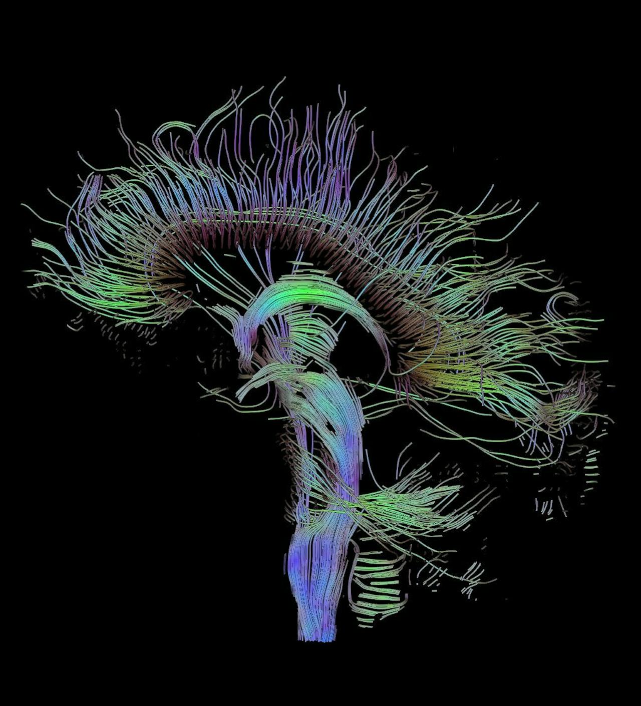 Een DTI-scan, een speciaal soort hersenscan die de verbindingen tussen delen van de hersenen weergeeft.