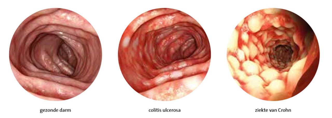 Drie close-ups van een darm: de linker is van een gezonde darm, de andere twee zijn van een persoon met een darmkwaal.
