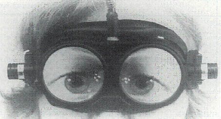 Close-up van een kind met de bril van Frenzel. Deze bril bevat glazen van 20 dioptrieën, waardoor het oog voor de onderzoekend arts vergroot wordt afgebeeld. Tegelijkertijd ziet de patiënt een heel onscherp beeld.