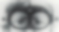 Close-up van een kind met de bril van Frenzel. Deze bril bevat glazen van 20 dioptrieën, waardoor het oog voor de onderzoekend arts vergroot wordt afgebeeld. Tegelijkertijd ziet de patiënt een heel onscherp beeld.