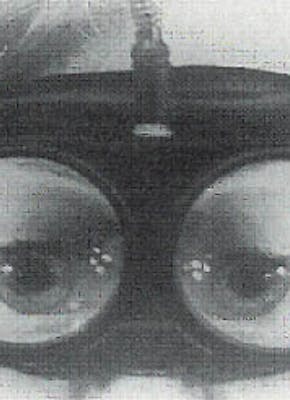 Close-up van een kind met de bril van Frenzel. Deze bril bevat glazen van 20 dioptrieën, waardoor het oog voor de onderzoekend arts vergroot wordt afgebeeld. Tegelijkertijd ziet de patiënt een heel onscherp beeld.