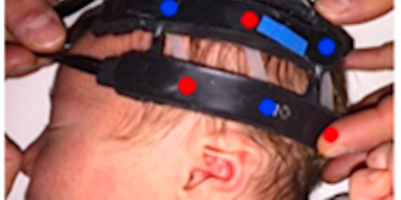 Een baby met banden op zijn hoofd, waarmee Near-Infrared Spectroscopy (NIRS) wordt toegepast.