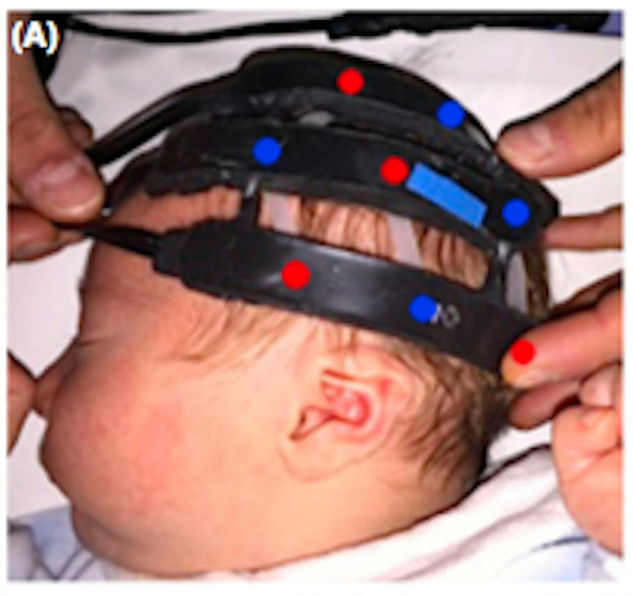 Een baby met banden op zijn hoofd, waarmee Near-Infrared Spectroscopy (NIRS) wordt toegepast.