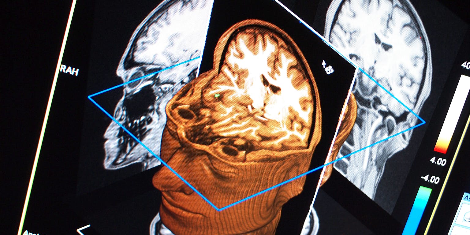 Een MRI-afbeelding van een menselijk hoofd.