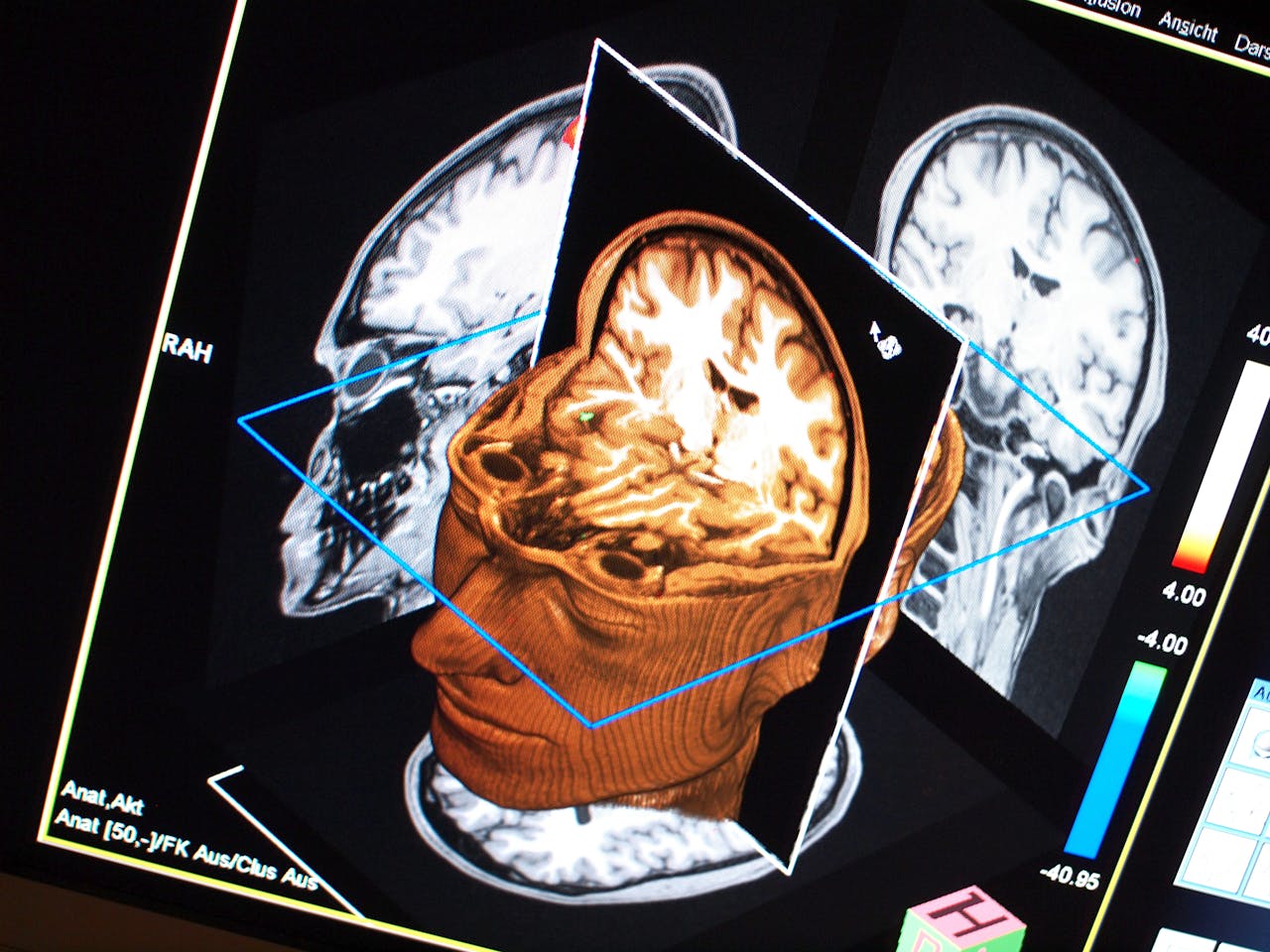 Een MRI-afbeelding van een menselijk hoofd.
