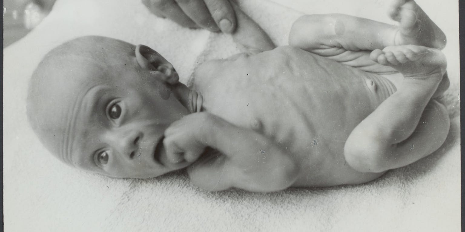 En ondervoede baby tijdens de Hongerwinter van 1944-1945.