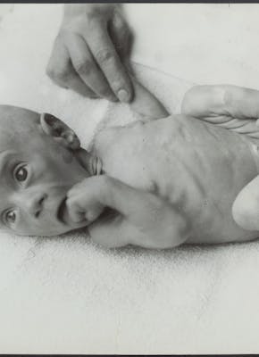 En ondervoede baby tijdens de Hongerwinter van 1944-1945.