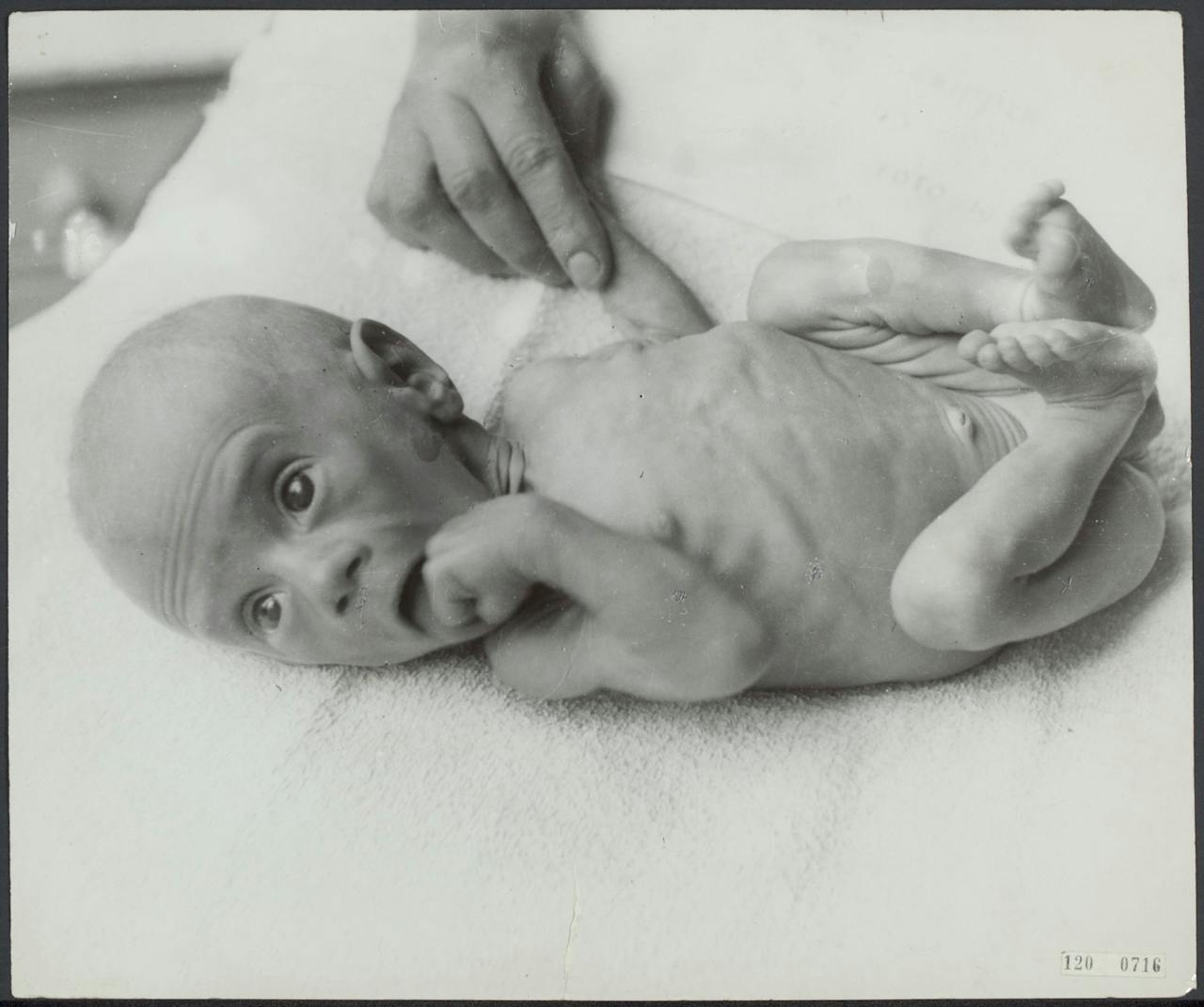 En ondervoede baby tijdens de Hongerwinter van 1944-1945.