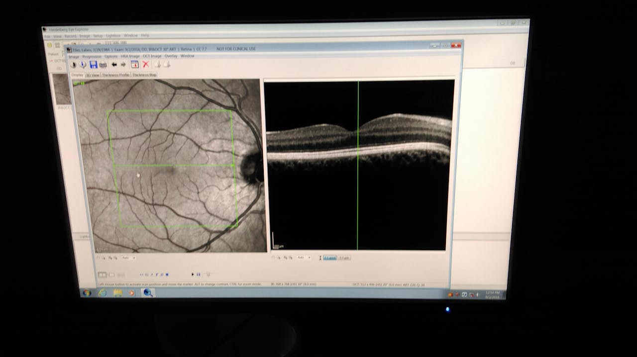 Resultaat van de scan van het netvlies van een gezond oog. Op het linkerplaatje zijn de oogzenuw (rechts), de gele vlek (stip in het midden) en bloedvaten te zien. De afbeelding rechts is de doorsnede, zoals die is gemaakt over de groene lijn in het midden van het groene vierkant. Het ‘kuiltje’ in de doorsnede is de gele vlek. Hier is het netvlies het dunst.