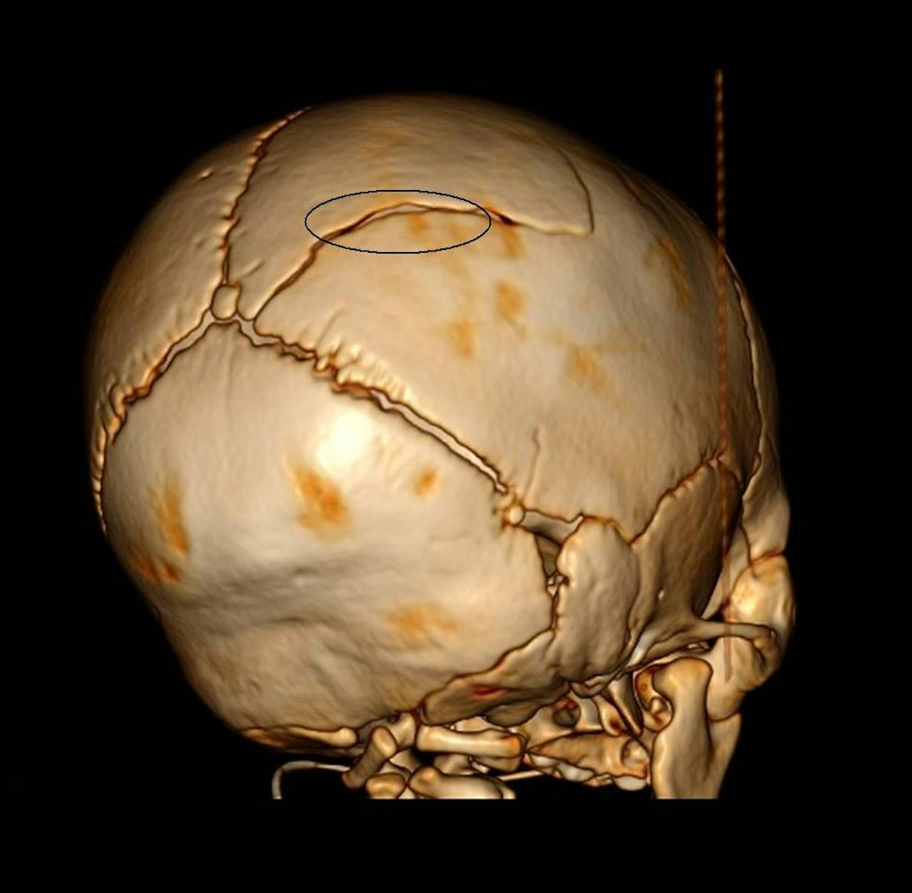 CT-scan van de schedel van een vier maanden oude jongen. In de cirkel is een breuk te zien, als gevolg van toegebracht schedelhersenletsel.