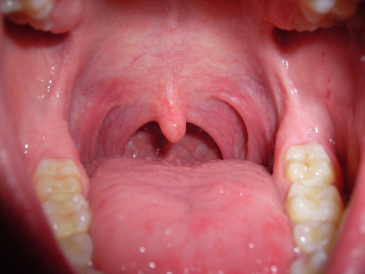 Een close-up van een geopende mond. De tanden, tong en huig zijn duidelijk zichtbaar.