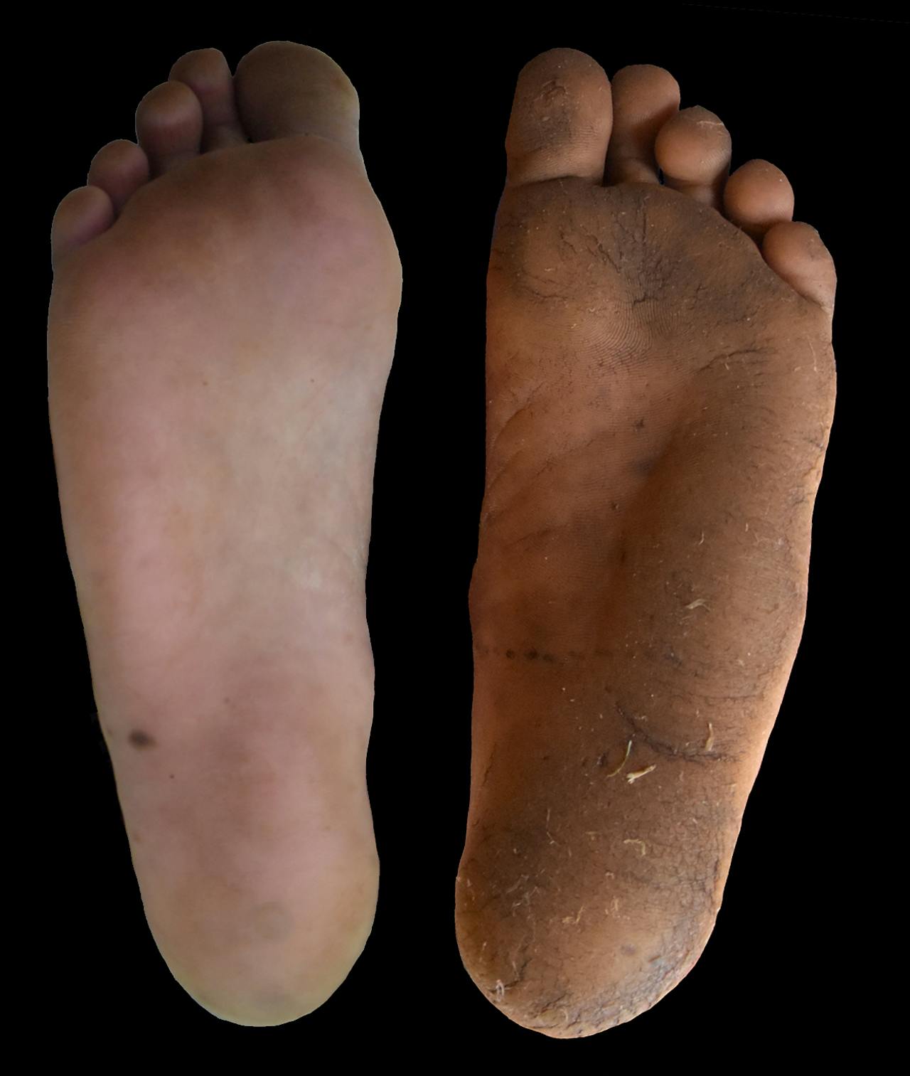 Twee voeten die het verschil laten zien tussen voeten zonder eelt en voeten met eelt.