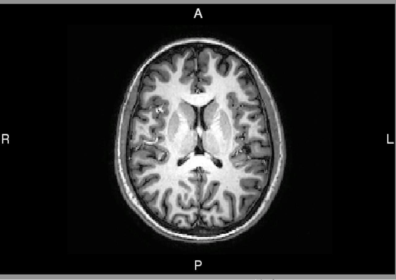 Een MRI-afbeelding van iemands hersenen.