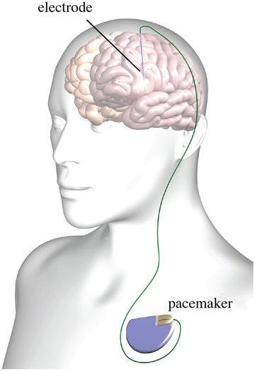 Een diagram van een brein met daarop electrode en een pacemaker afgebeeld.
