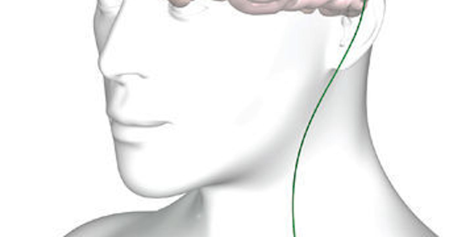 Een diagram van een brein met daarop electrode en een pacemaker afgebeeld.
