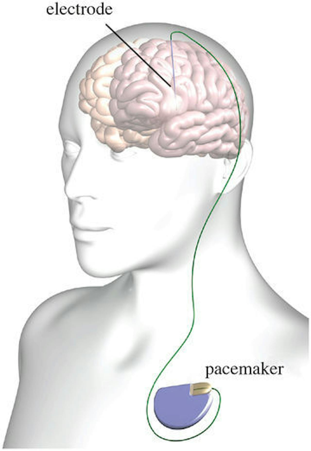 Een diagram van een brein met daarop electrode en een pacemaker afgebeeld.