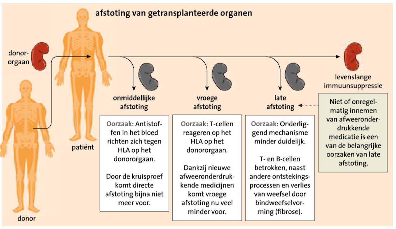 Een tekening van de verschillende soorten afstoting van getransplanteerde organen.