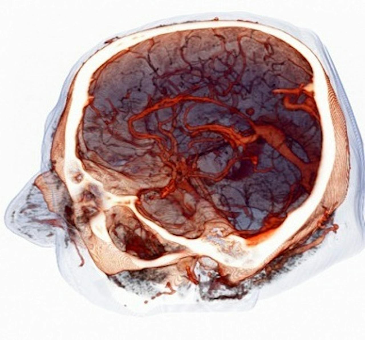 Een afbeelding waar de bloedvaten van het brein op te zien zijn.