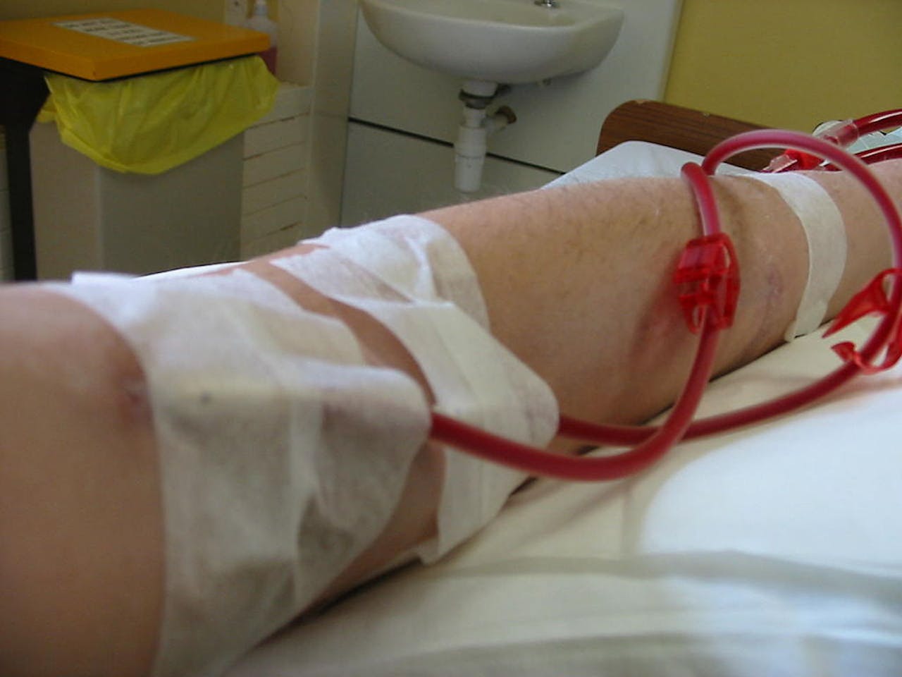 Langdurig dialyseren zonder naalden is op dit moment nog niet mogelijk. Dialyse