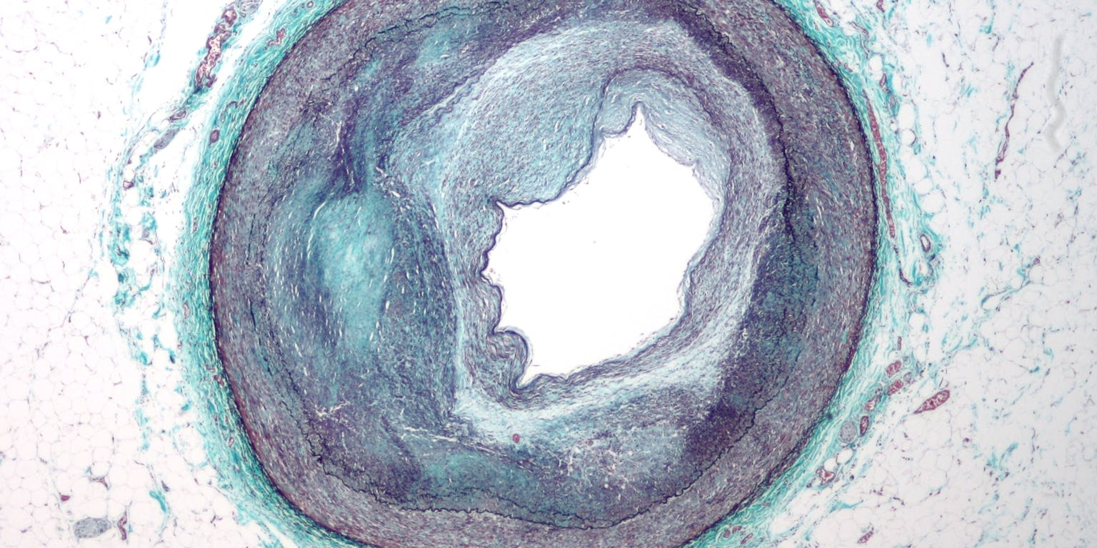 Aangekleurde opname van een doorsnede van een slagader die voor nog slechts 25 procent geopend is. Het grillig gevormde middenstuk is de groeiende plaque.