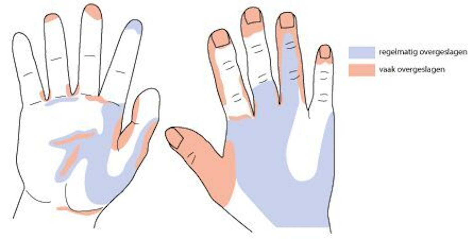 Een diagram dat de voor- en achterkant van een hand laat zien. In twee verschillende kleuren wordt aangegeven welke delen regelmatig- of vaak worden overgeslagen tijdens het handen wassen.