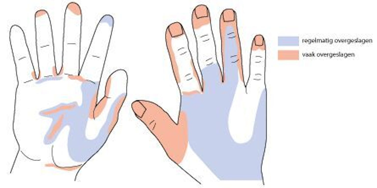 Een diagram dat de voor- en achterkant van een hand laat zien. In twee verschillende kleuren wordt aangegeven welke delen regelmatig- of vaak worden overgeslagen tijdens het handen wassen.