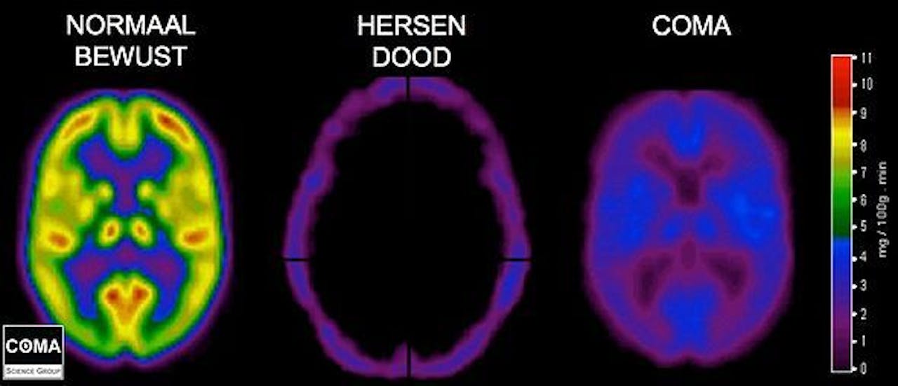 Drie beelden van de hersenen, waarbij de vergelijking wordt gemaakt tussen normaal bewust, hersendood en coma.