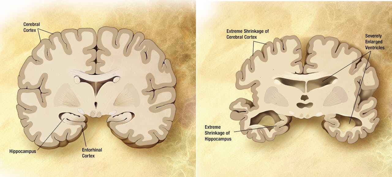 Twee afbeeldingen van hersenen, waarbij het verschil wordt getoond tussen gezonde hersenen en de hersenen van iemand met Alzheimer.