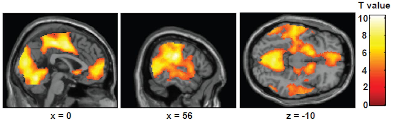 fMRI-scans die het verschil laten zien tussen de activiteit tijdens een correct en een incorrect beantwoorde vraag. Het betreft drie verschillende virtuele doorsnijdingen van de hersenen.