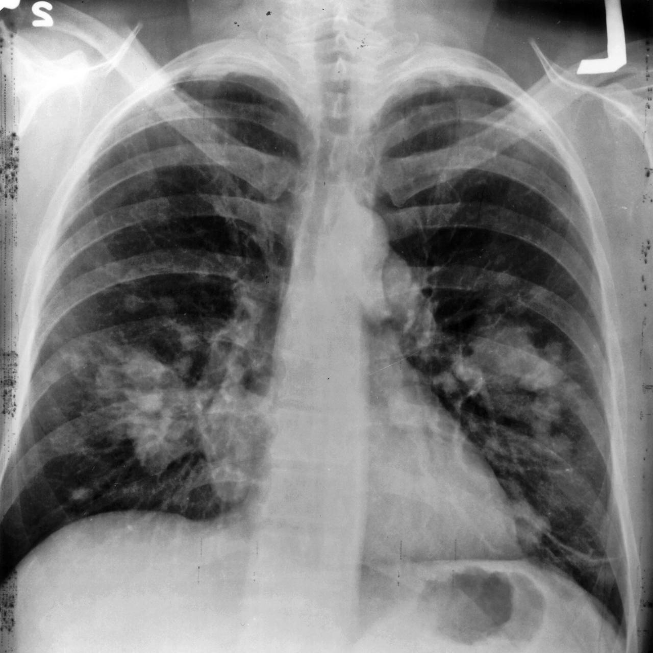 Een zwart-wit röntgenfoto van een patiënt met longkanker.