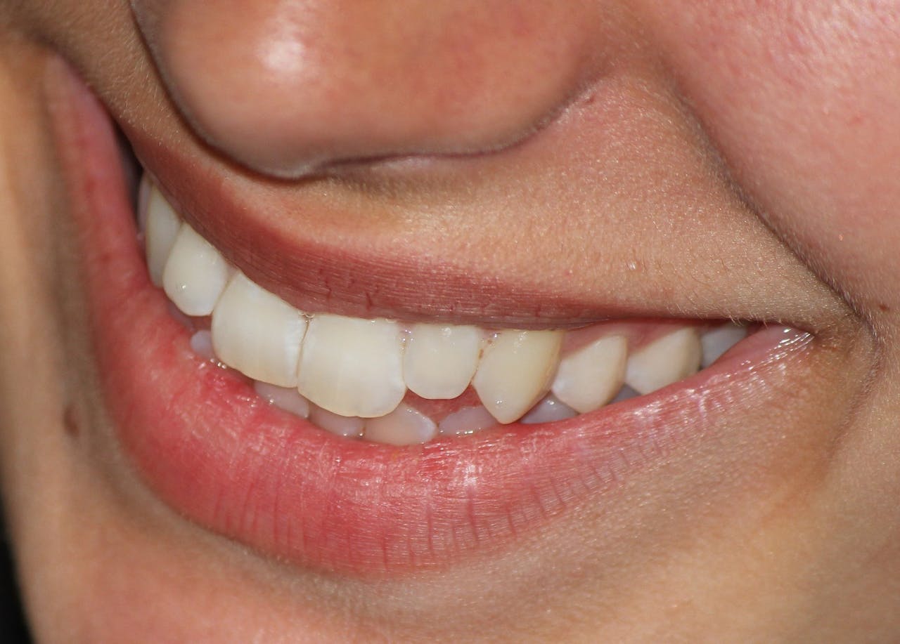 Een close-up van de tanden van een vrouw.